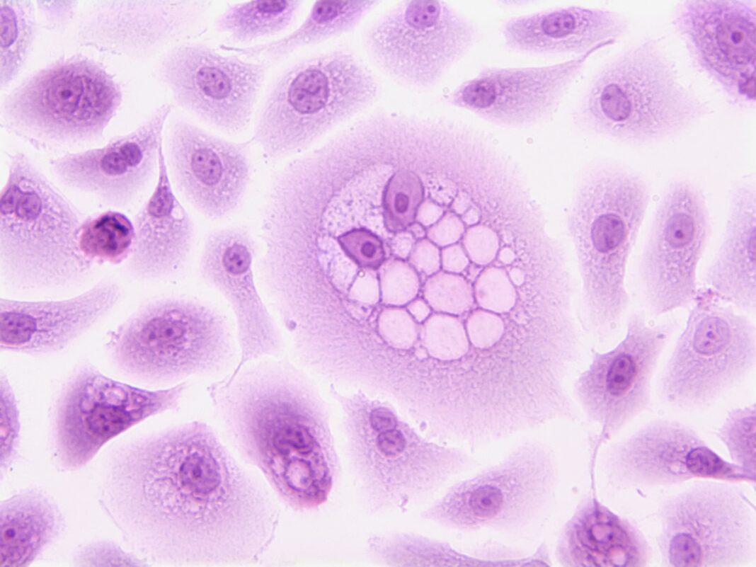 Células de cáncer vistas con un microscopio
