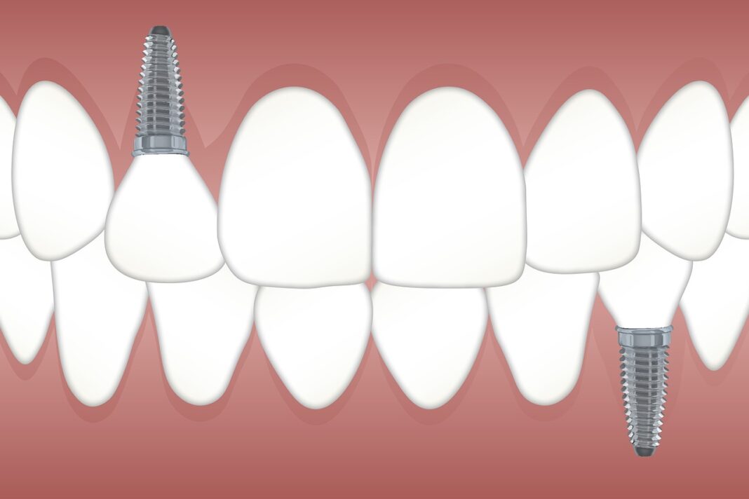 simulación de implante dental
